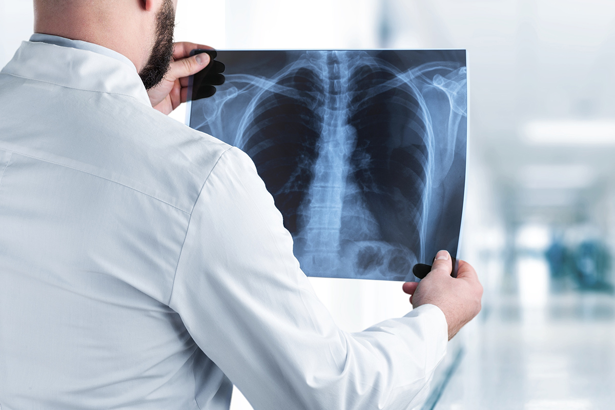 Complete Read A Chest Radiograph Of Pneumonia Findings