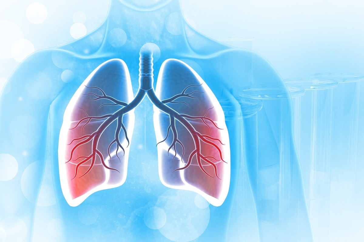 Acute Bronchitis: 7 Key Facts & Diagnosis