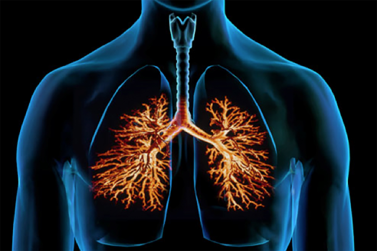 Acute Bronchitis: 7 Key Facts & Diagnosis