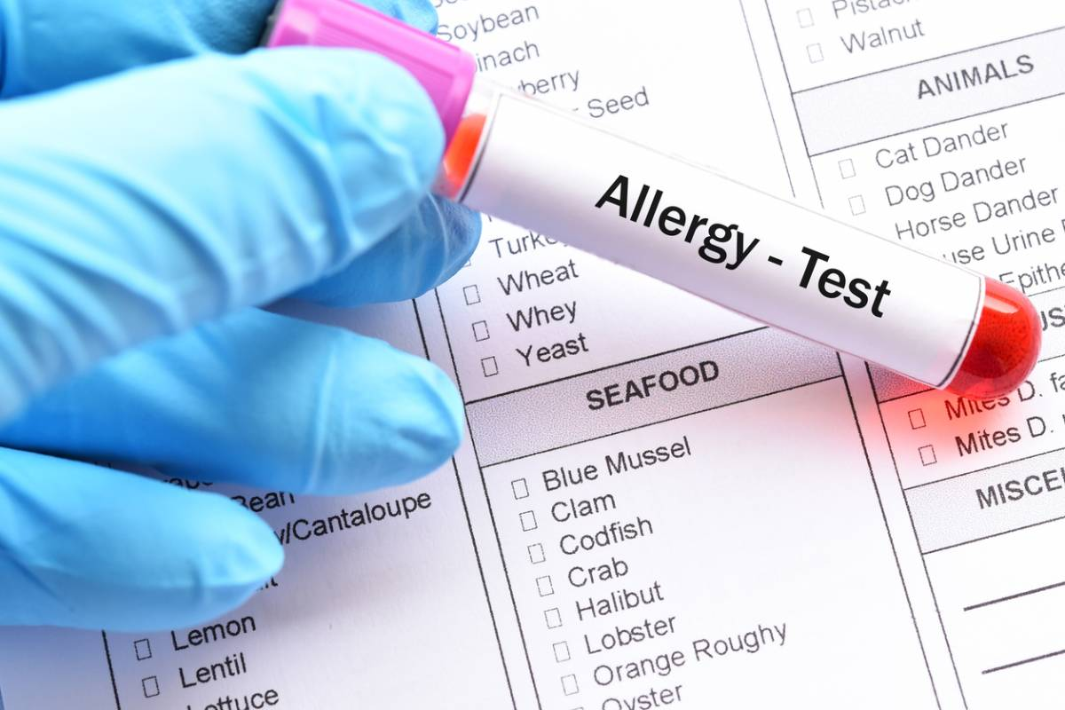 How to Read Allergy Scratch Test Results