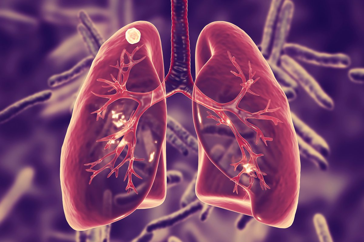 Mild COPD Life Expectancy: Best Prognosis