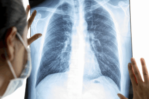Death From COPD Disease: Critical Facts