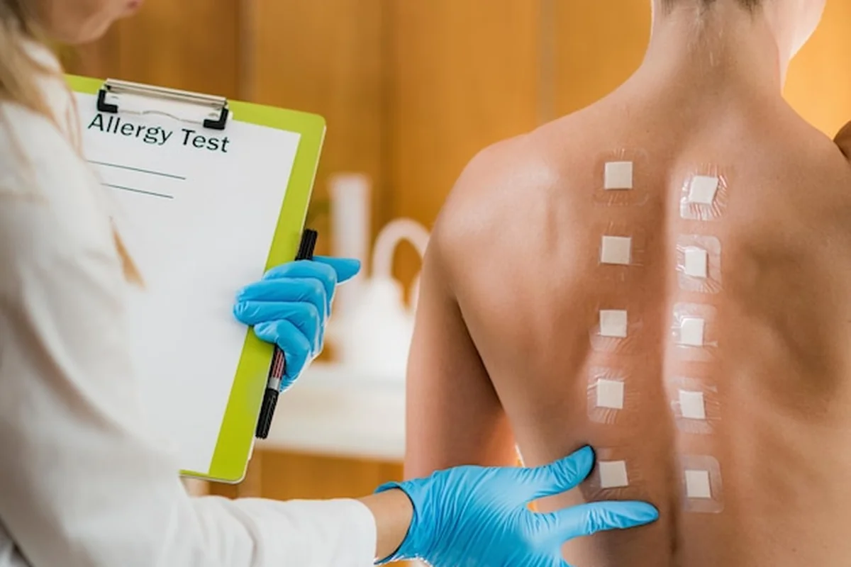 Allergy Patch Test: Best Reading Guide