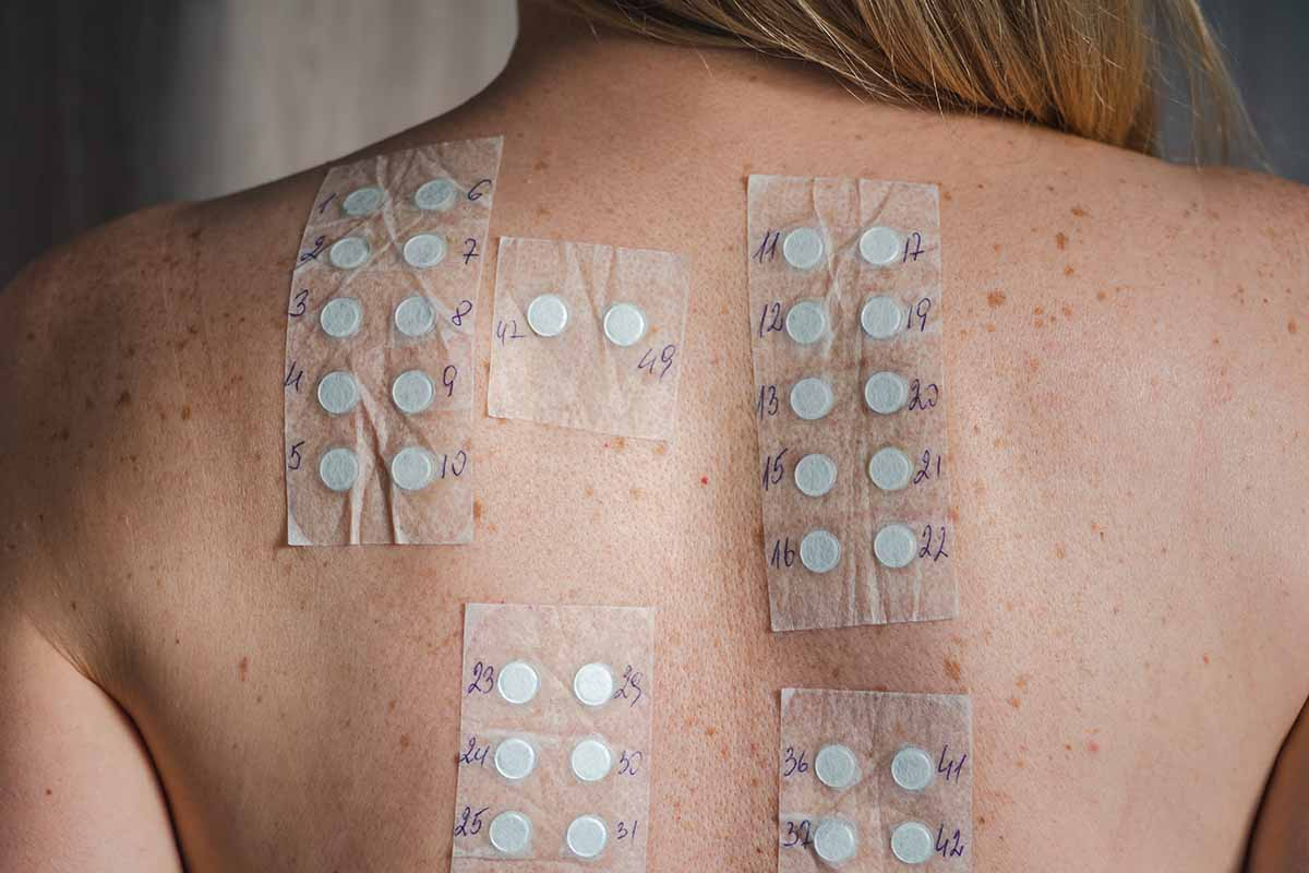 Allergy Patch Test: Best Reading Guide