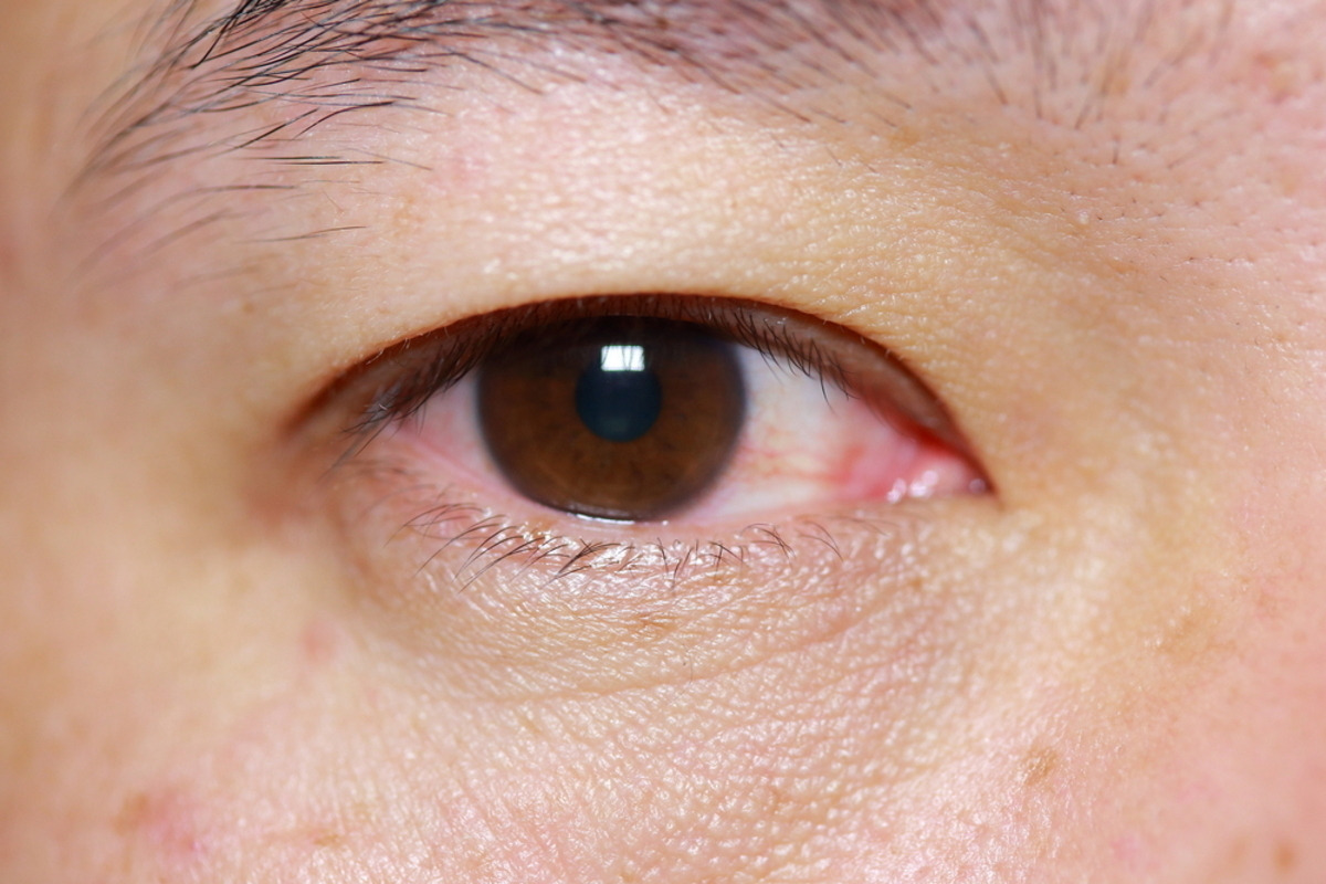 Why Is My Eye Red and Itchy? 7 Causes