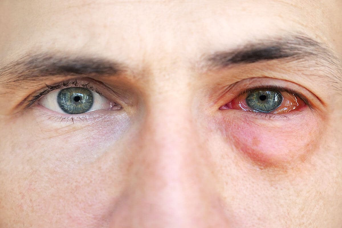 Allergies in One Eye: Causes & Fixes
