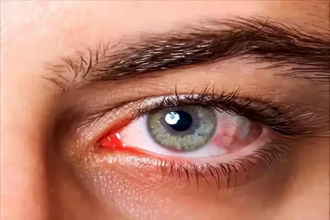 What to Do If I Have Allergies in My Eyes