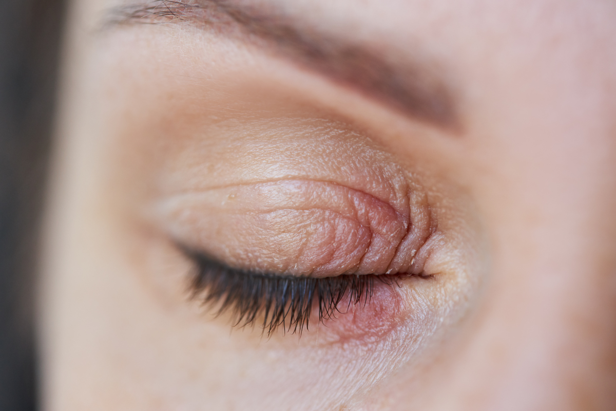 Contact Dermatitis Around Eyes: Care
