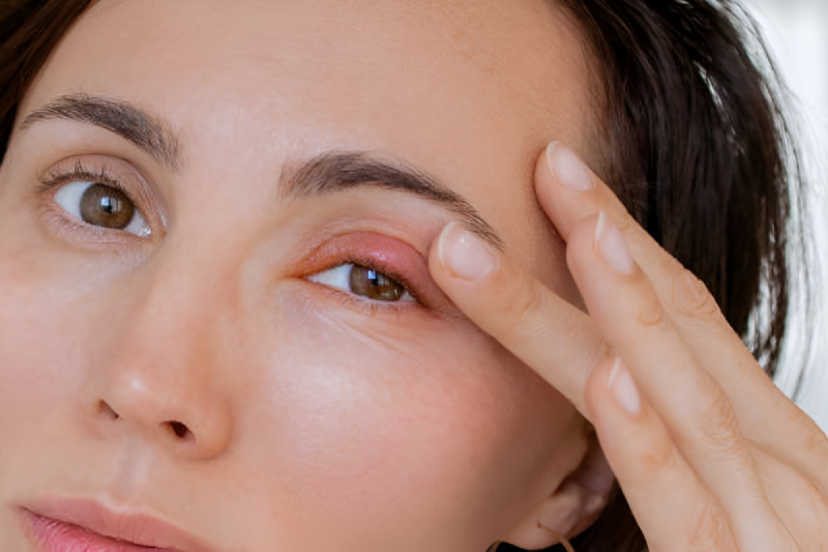 How to Help Swollen Eyes From Allergies