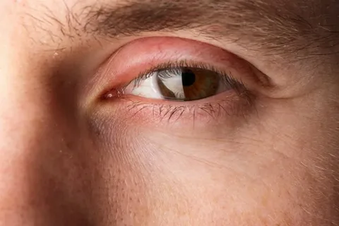 What to Do for Severe Eye Allergies?