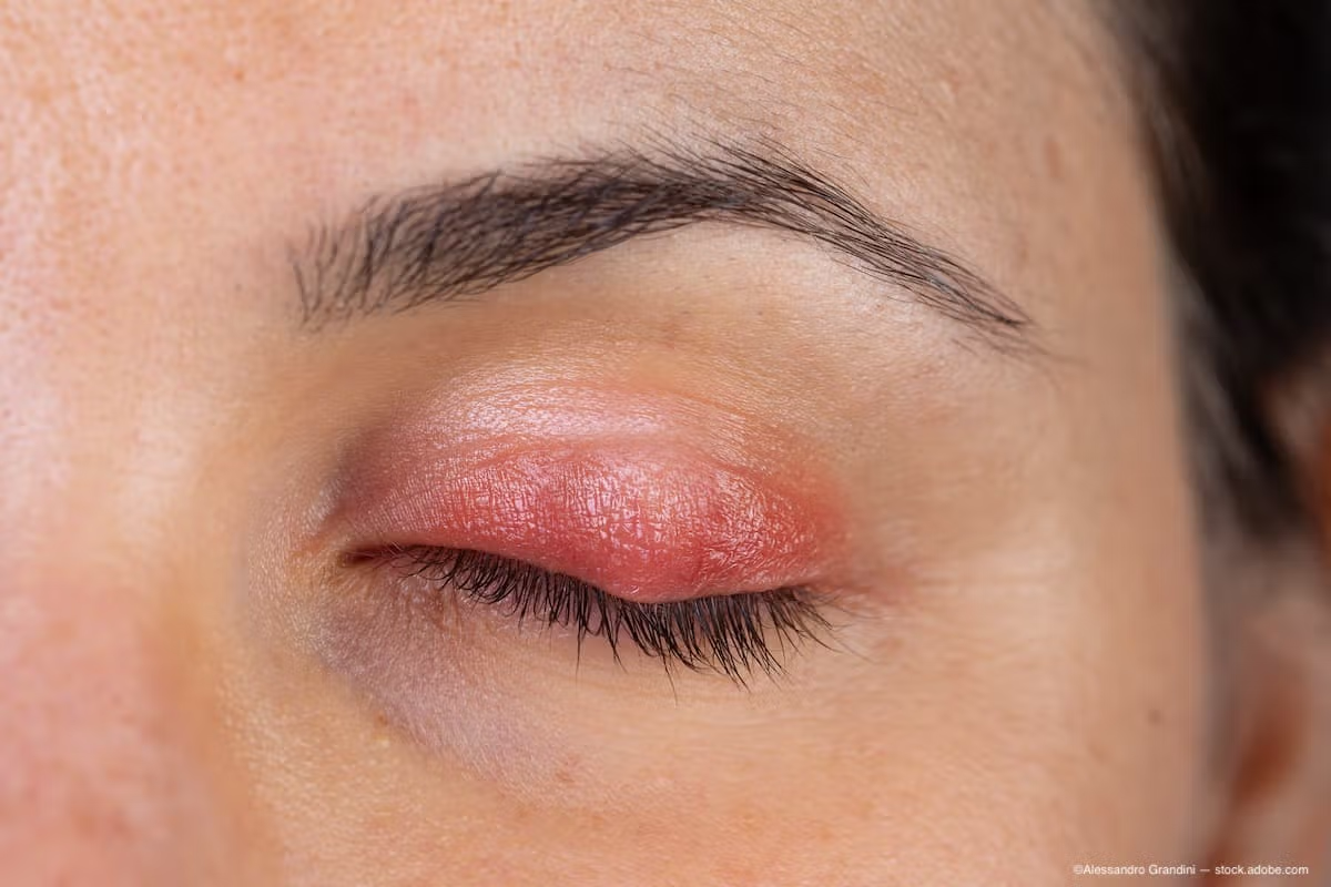 Swollen Eyelid From Allergies: Fixes