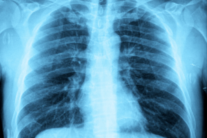 Insightful Quick Relief Steps To Clear Lung Congestion