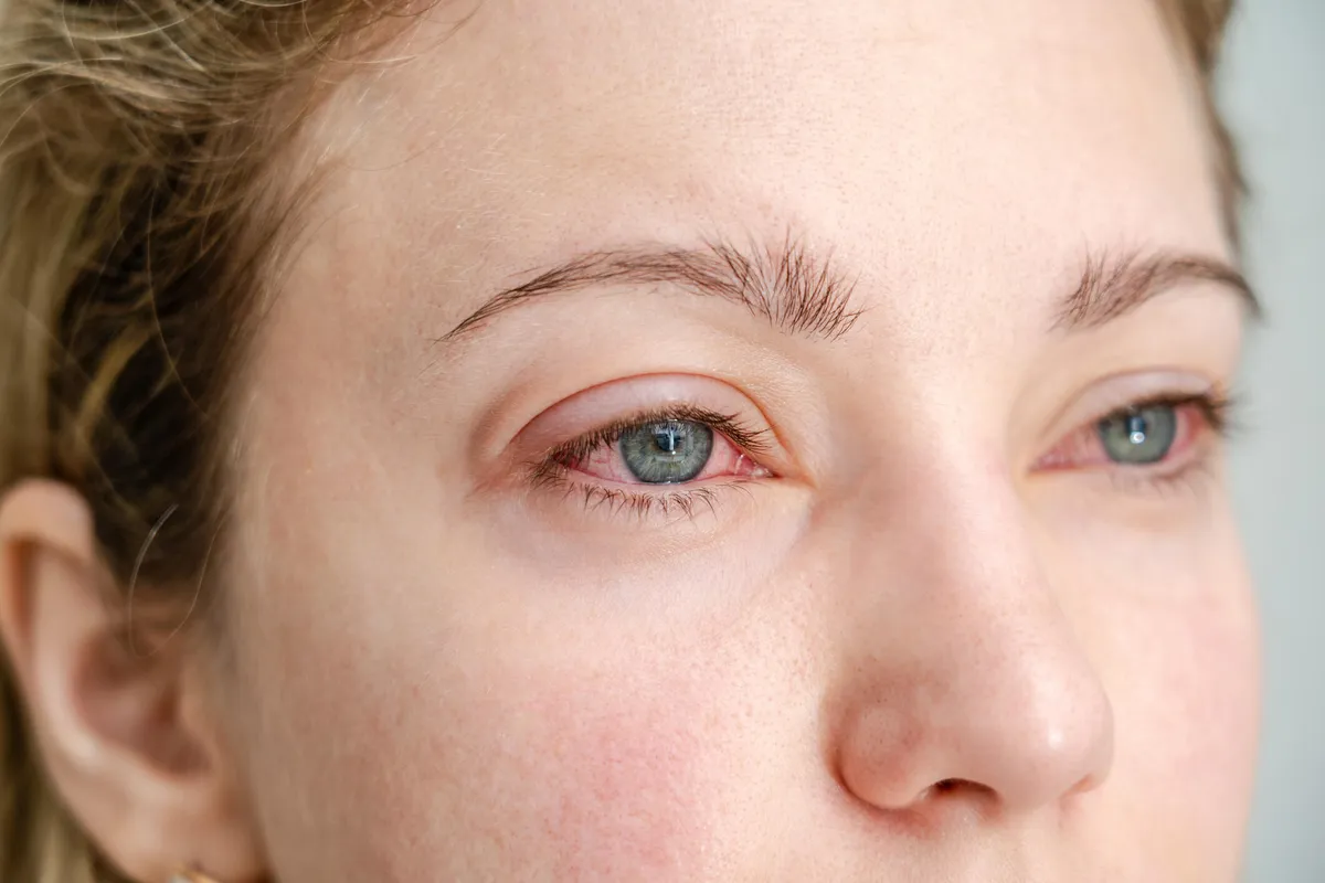 What to Do for Severe Eye Allergies?