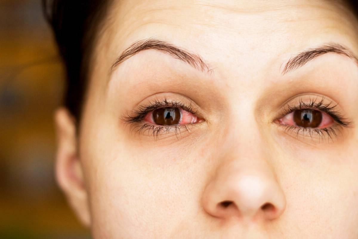 How to Treat Allergic Conjunctivitis 2 How to Treat Allergic Conjunctivitis