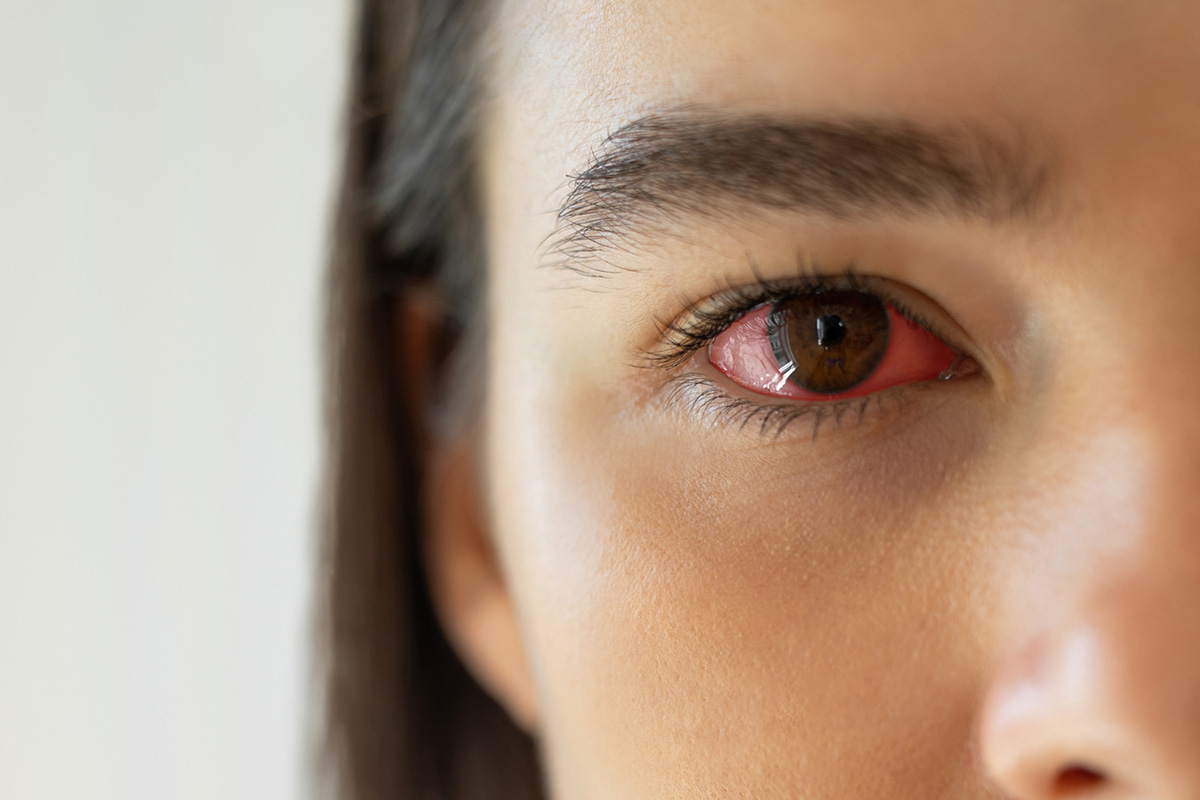 Allergies in One Eye: Causes & Fixes