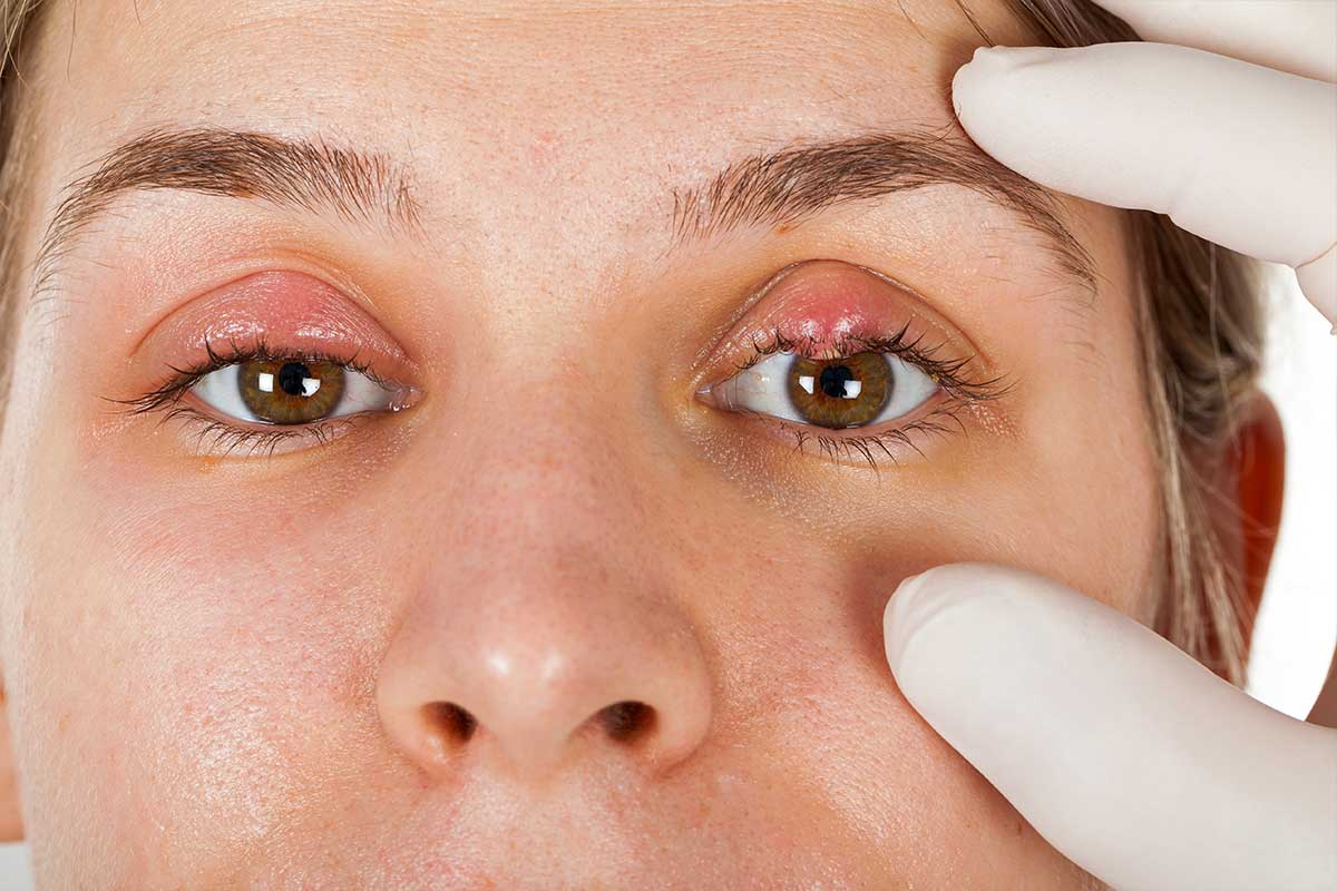 How to Help Swollen Eyes From Allergies