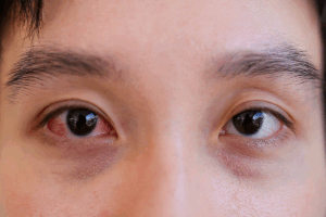 How to Treat Allergic Conjunctivitis