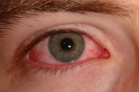 Allergies in One Eye: Causes & Fixes
