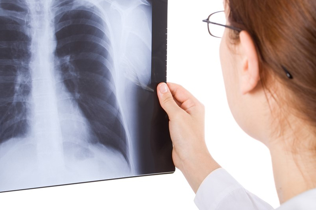 Bronchitis CXR: 5 Vital X-Ray Findings 1 Bronchitis CXR: 5 Vital X-Ray Findings
