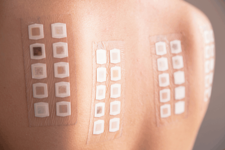 Allergy Skin Test on Back: Best Reading