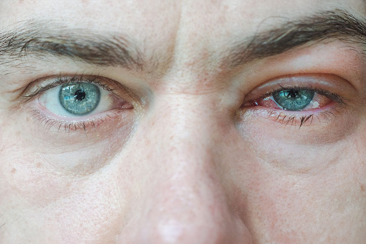 Valuable How To Stop Itchy Cat Allergy Eyes Quickly