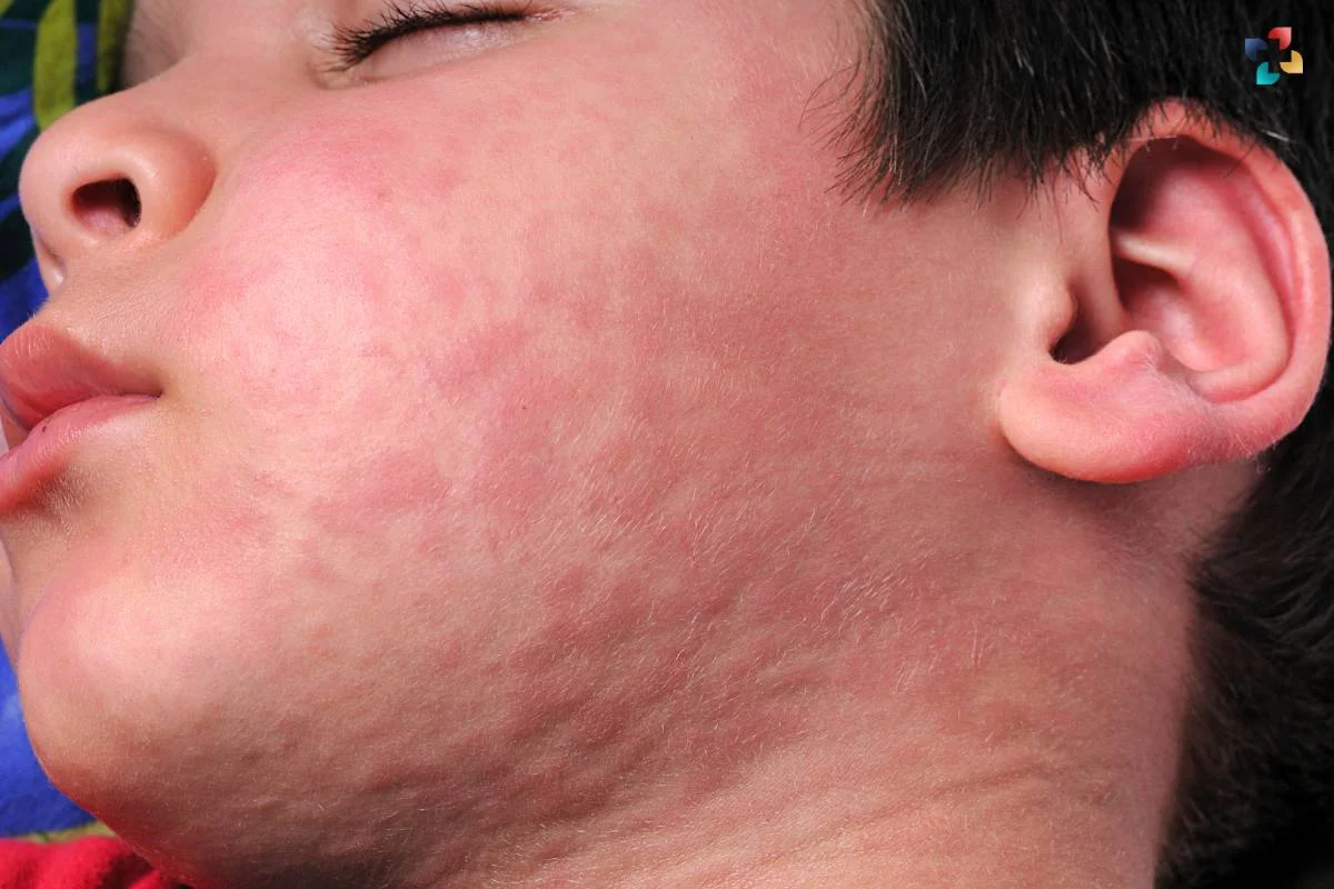 Signs of Allergies in Infants: Essential List