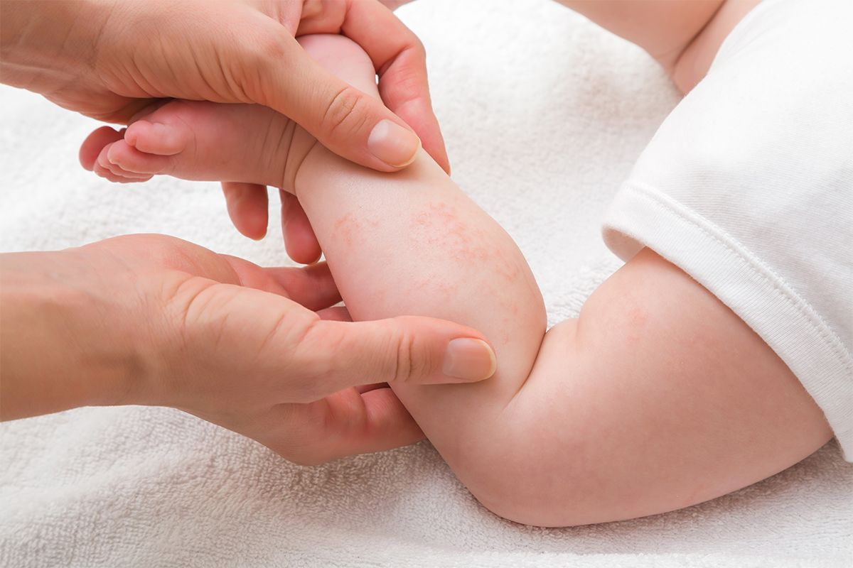 Newborn Food Allergy Rash: Key Signs
