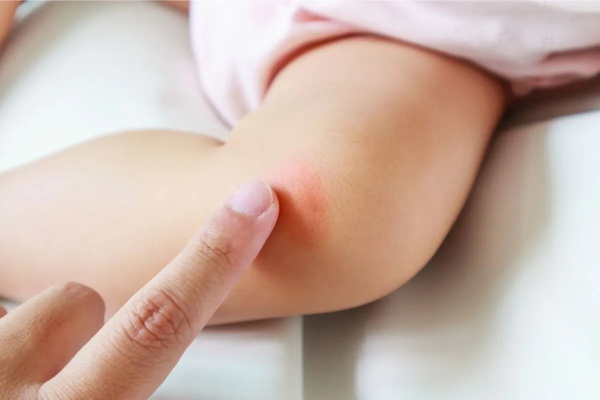 Food Allergies in Babies: 7 Key Signs