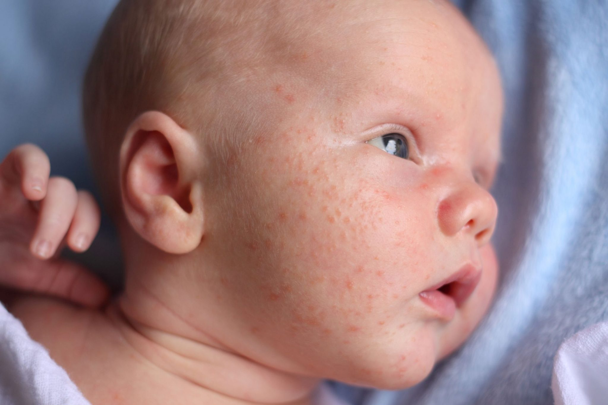 Signs of Allergies in Infants: Essential List