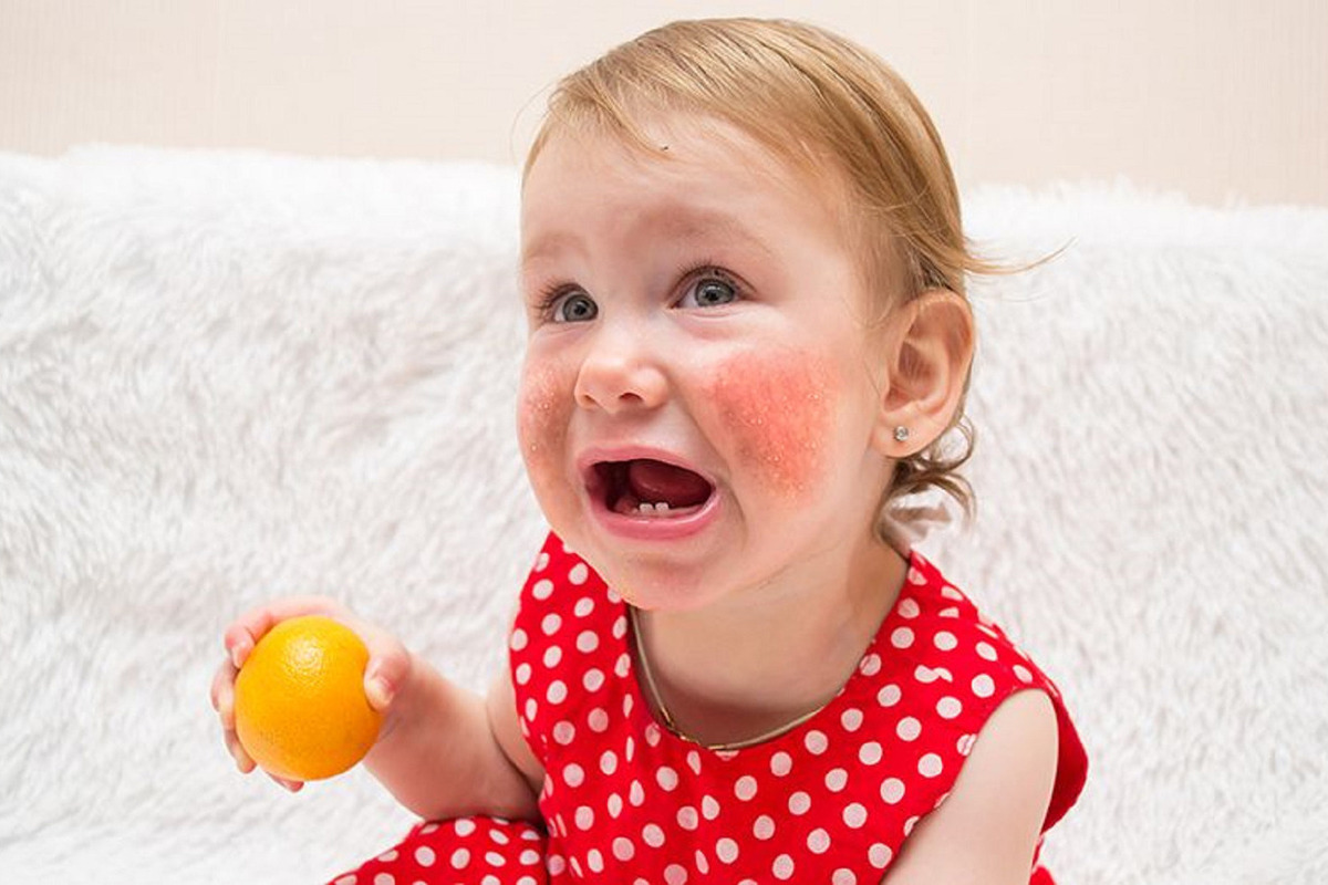 Signs of Food Allergy in Baby: 7 Top Alerts