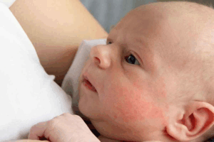 Newborn Food Allergy Rash: Key Signs