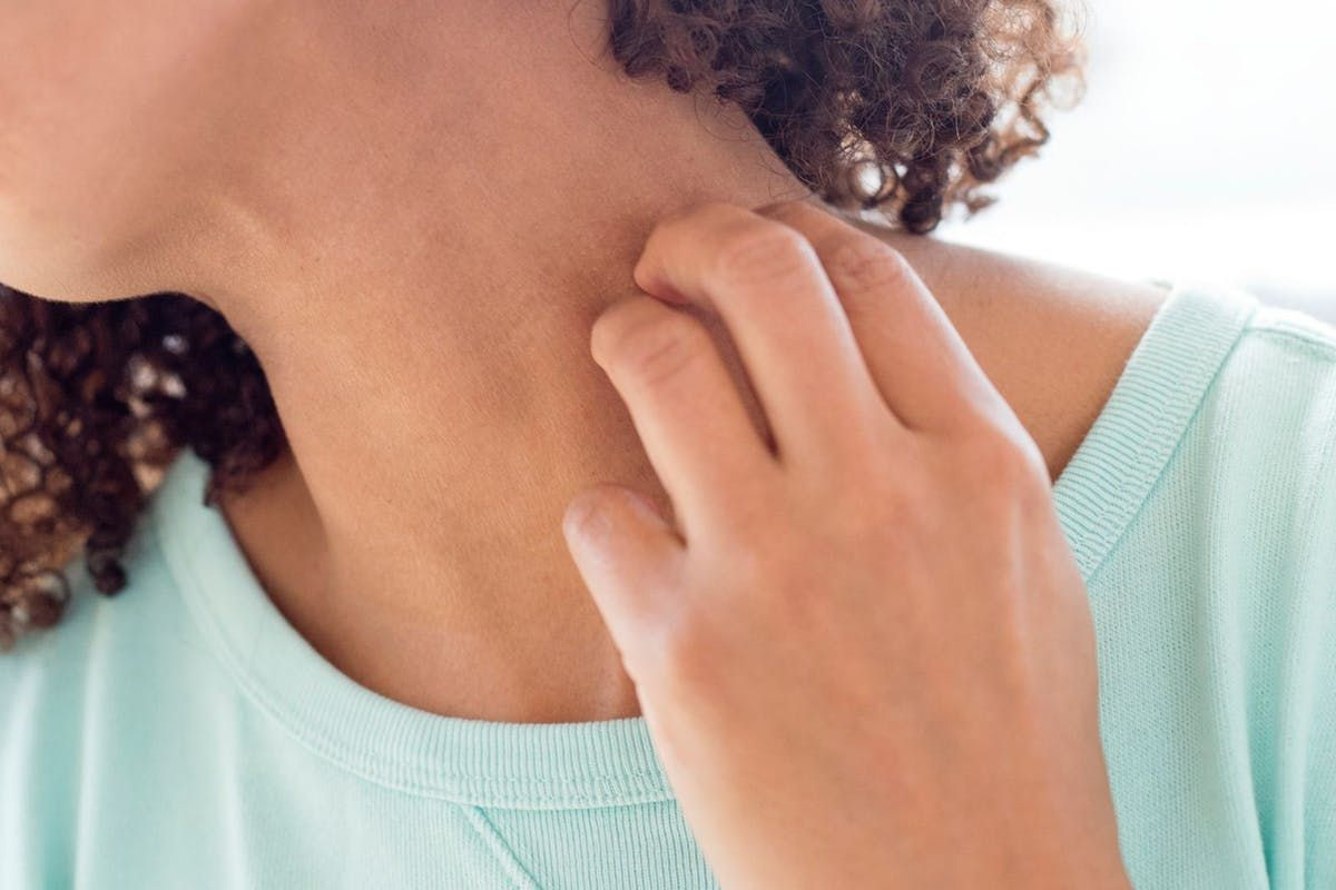 How Long Do Hives Last in Adults? Timeline