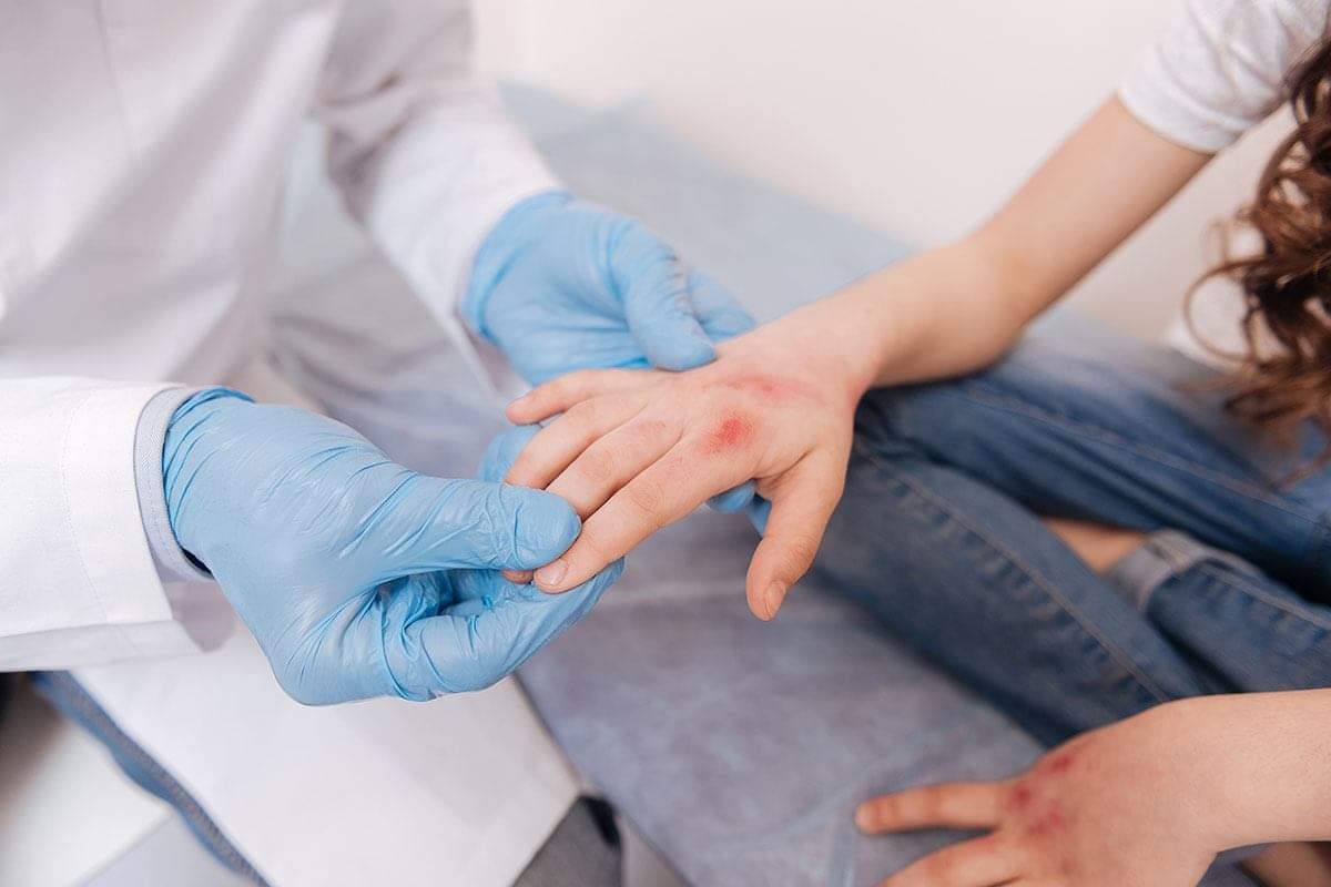 How Long Do Hives Last in Adults? Timeline