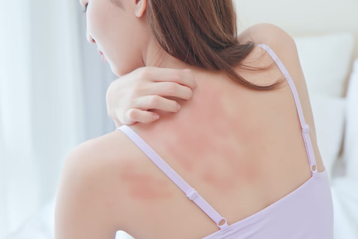 Do Welts Itch? Vital Facts About Hives