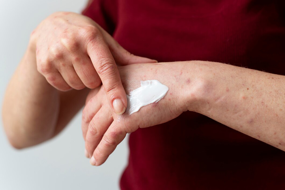 Itch Medicine: 5 Best Pills and Creams