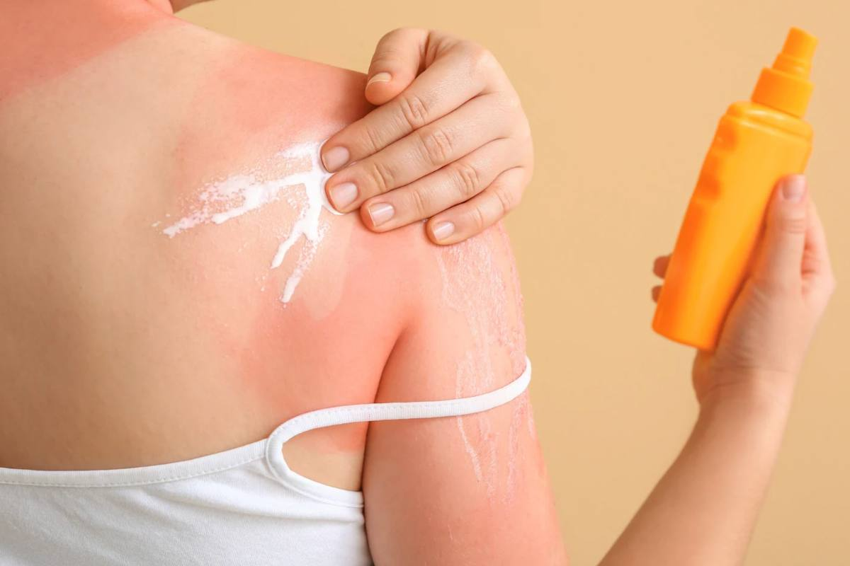 Antihistamine Anti Itch: Best Cream Use