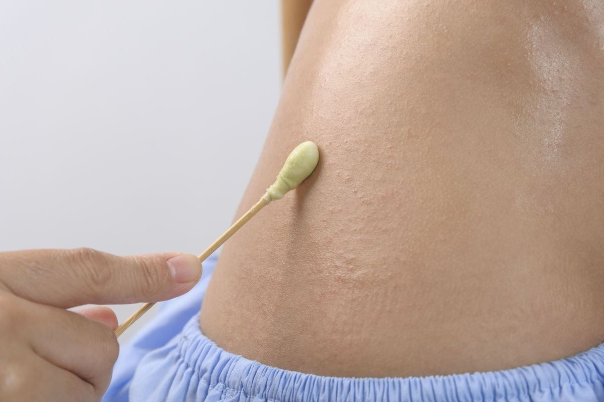 Different Types of Hives: 7 Critical Forms