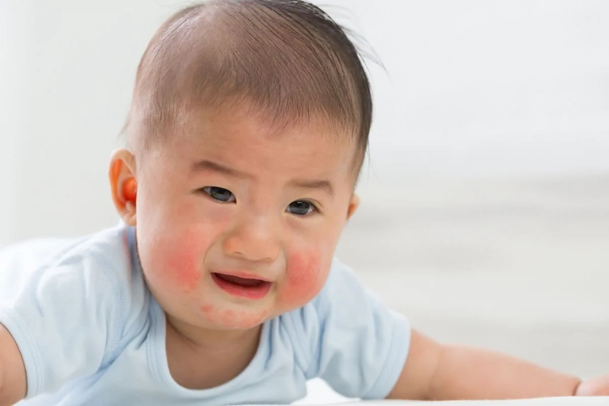 Can Infants Have Allergies? Vital Facts 3 Can Infants Have Allergies? Vital Facts