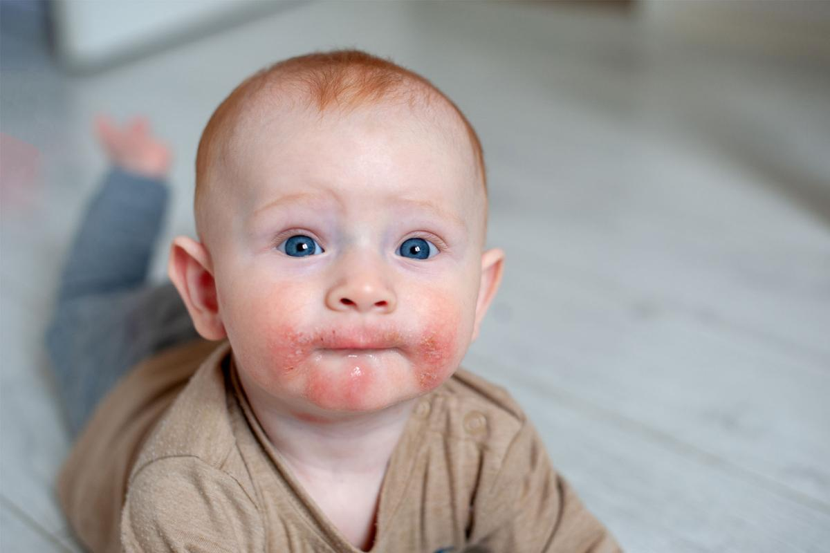 Infants and Food Allergies: 7 Critical Signs