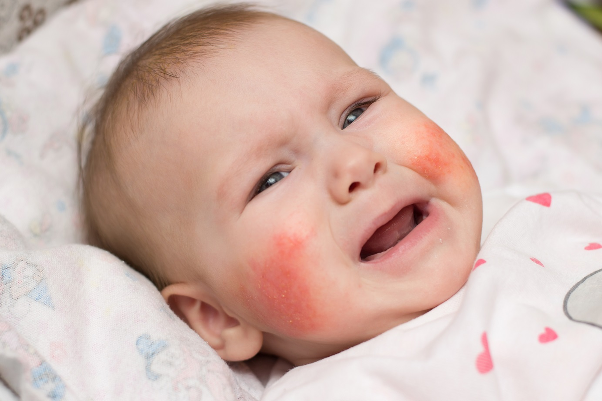 Infants and Food Allergies: 7 Critical Signs