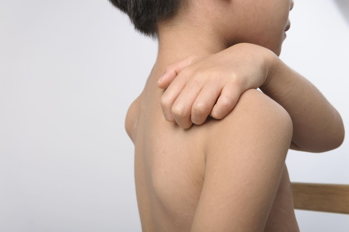 Is Urticaria Contagious? Vital Safety Facts