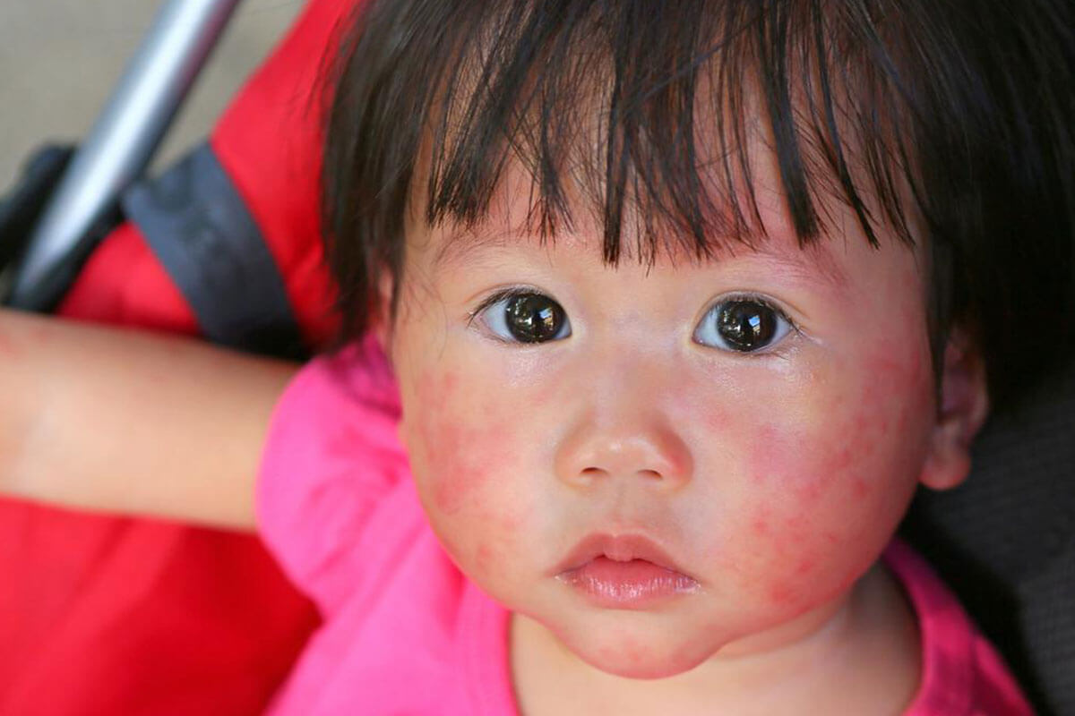 Is Urticaria Contagious? Vital Safety Facts