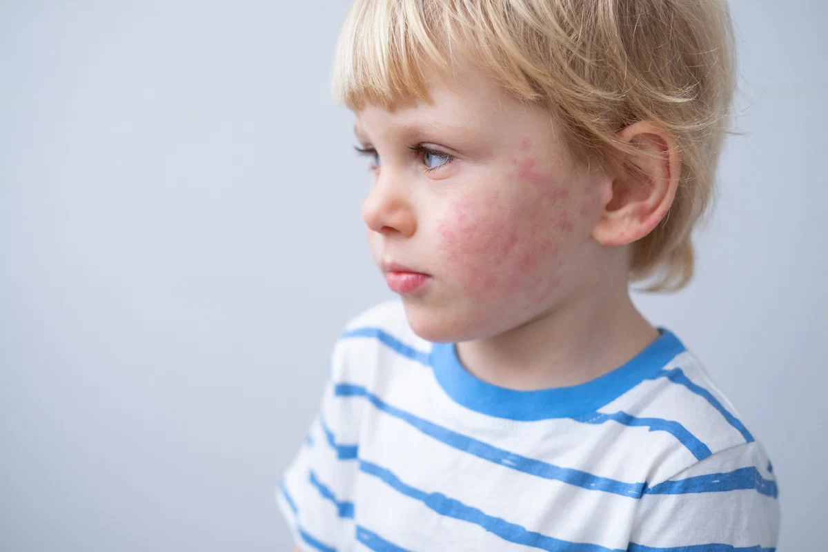 Adhesive Allergy: Symptoms & Relief
