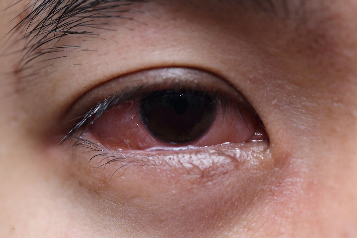 Allergy Eye Problems: Best Solutions 3 Allergy Eye Problems: Best Solutions