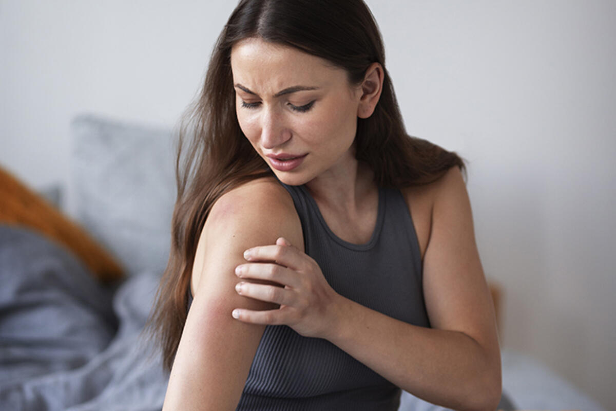 Hives on Inner Thighs Urticaria: Relief