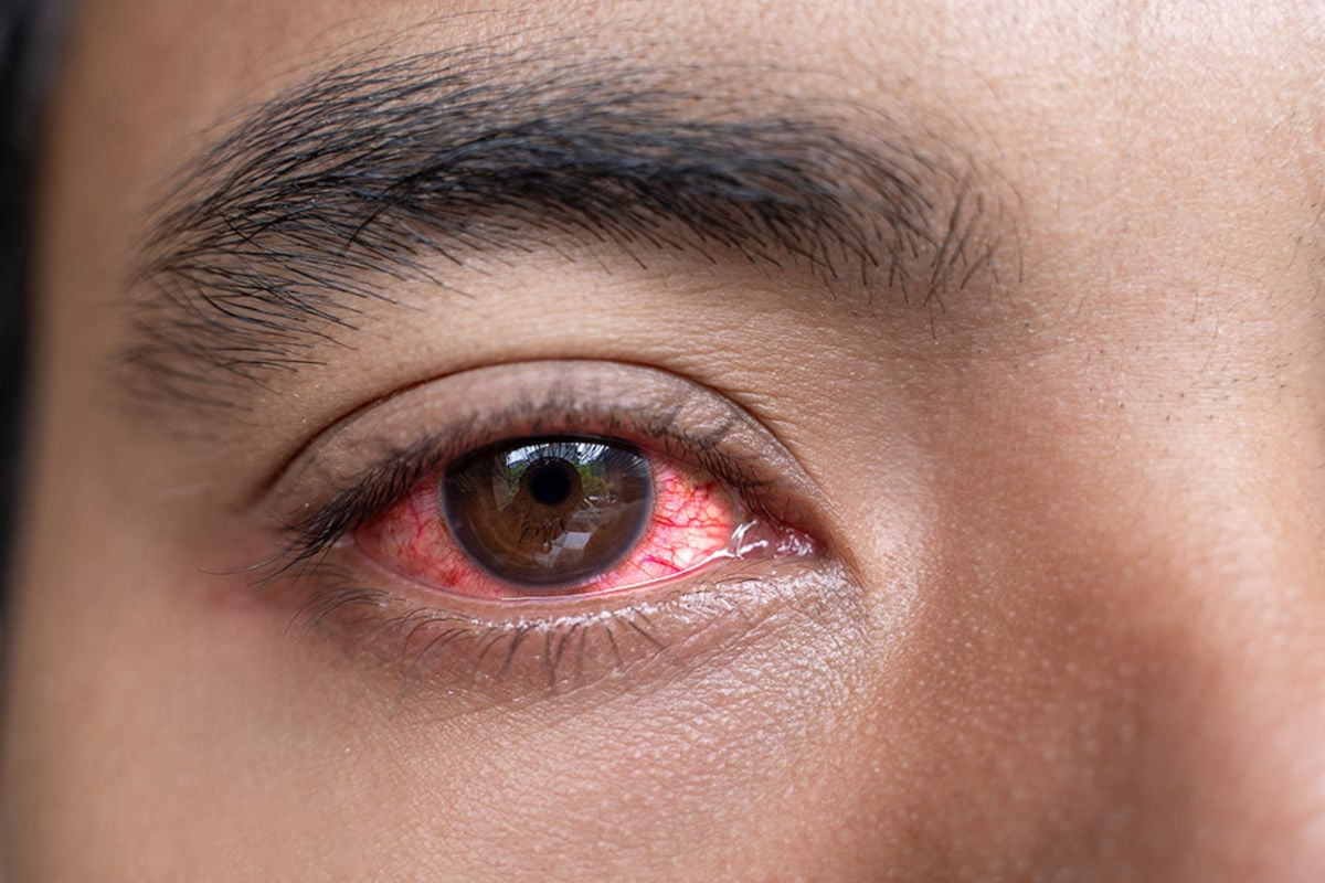Allergic Conjunctivitis or Pink Eye?