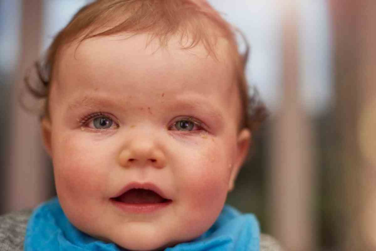 Allergy Infant: 5 Vital Warning Signs