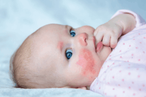 Infant Allergic Reaction: 7 Critical Signs