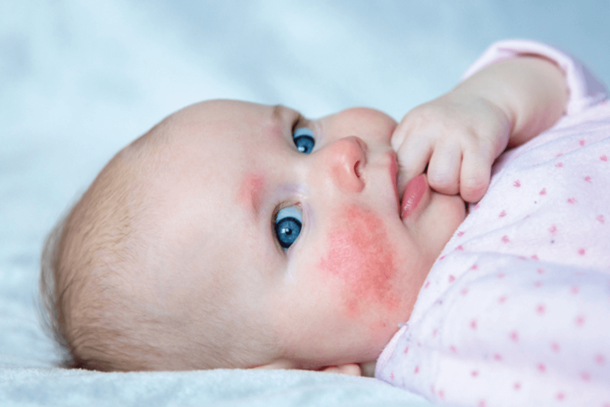 Infant Allergic Reaction: 7 Critical Signs 1 Infant Allergic Reaction: 7 Critical Signs