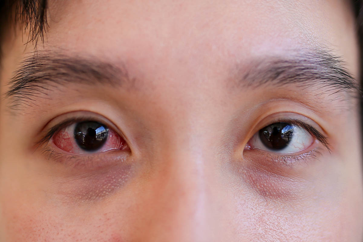Pink Eye vs Allergic Reaction: Key Signs 3 Pink Eye vs Allergic Reaction: Key Signs